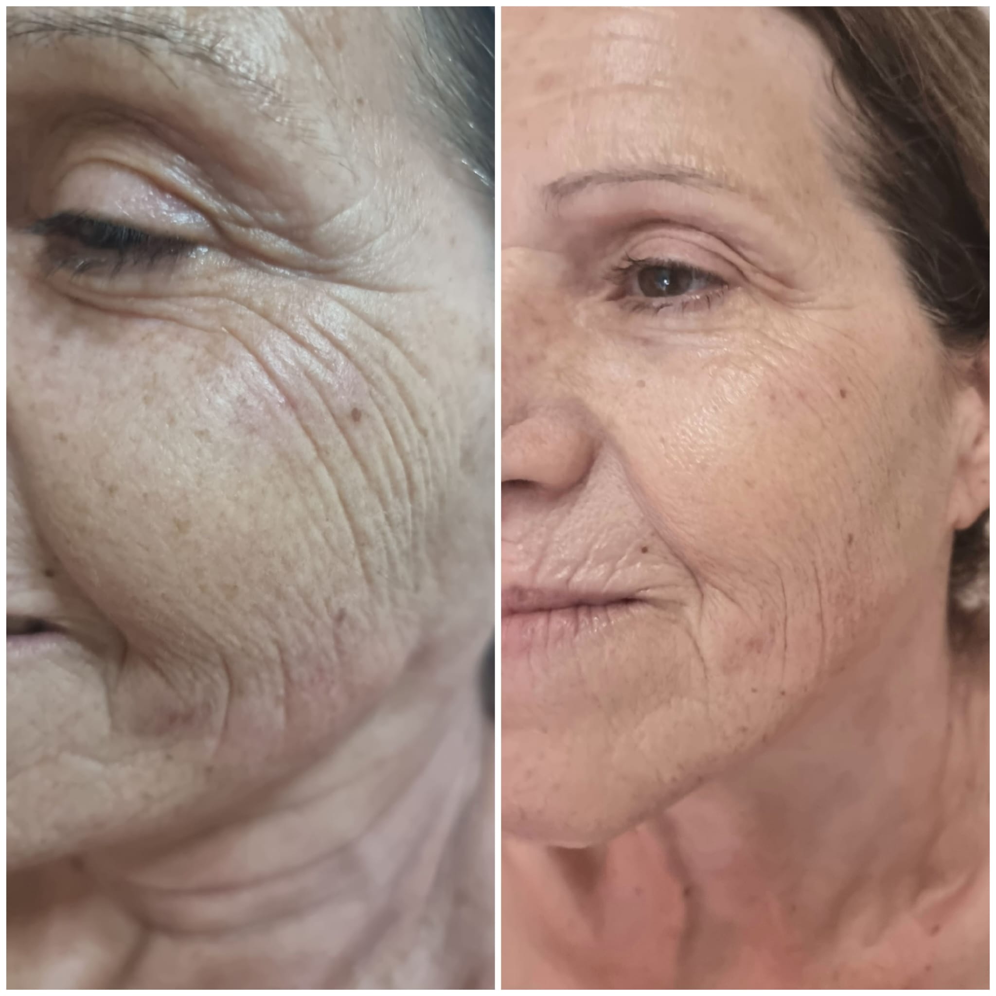 טיפולי פנים - Zora Face Treatment